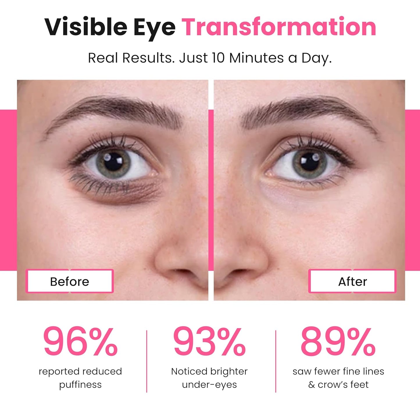 Terapia de luz roja para ojeras y bolsas para los ojos, Bea.